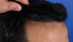 Before Hair Transplant&nbsp;Front